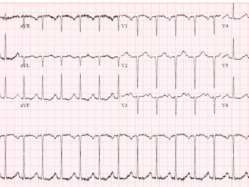 Critical Cases - Diphenhydramine Overdose!