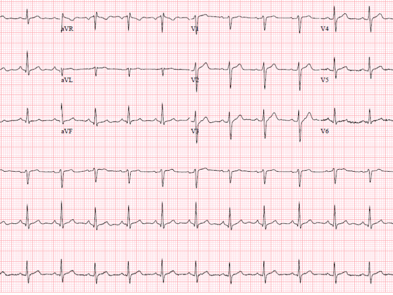 Critical Cases - Spontaneous pneumothorax!