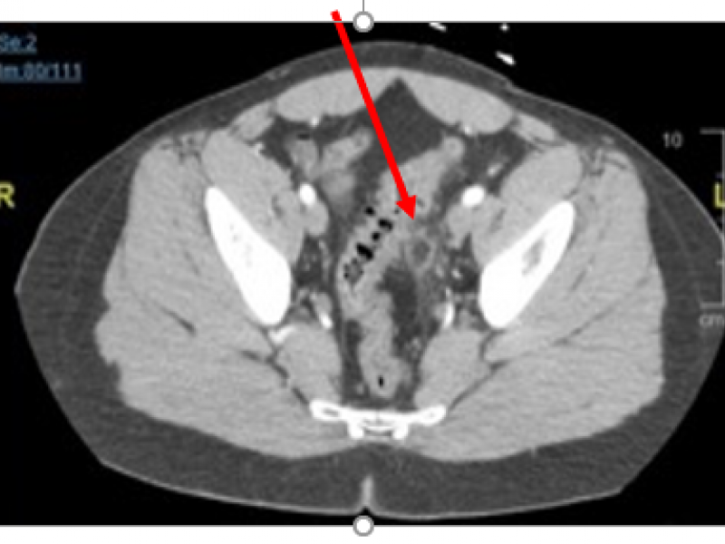 Critical Cases - Abdominal Pain in Covid-19 Infection!