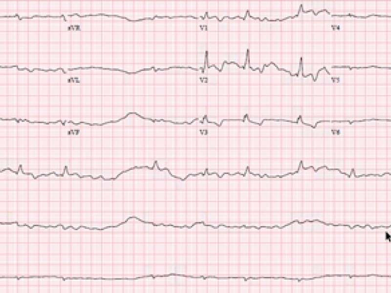 Critical cases - Digoxin toxicity!