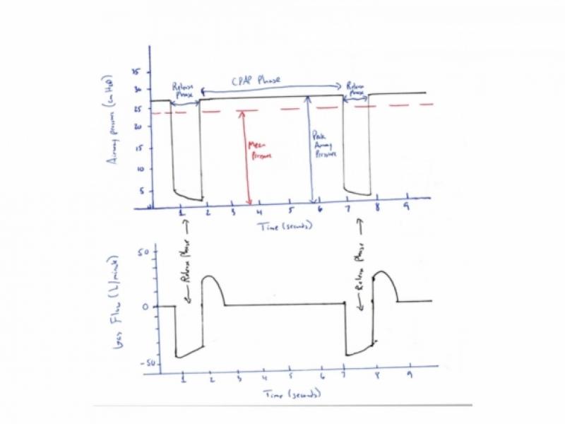 The basics of Airway Pressure Release Ventilation (APRV)