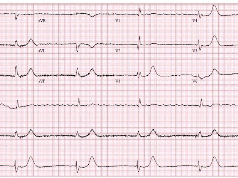 Critical Cases - Bradycardia Emergency!