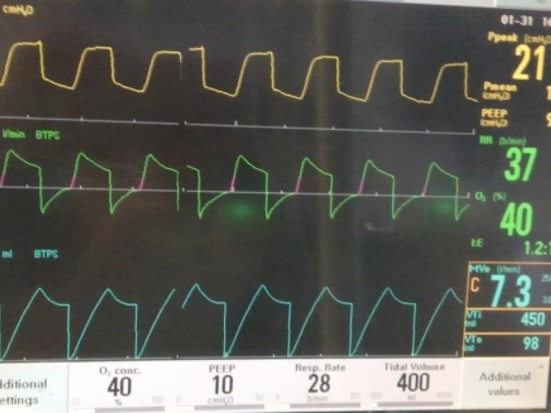 Ventilator management of bronchopleural fistula 