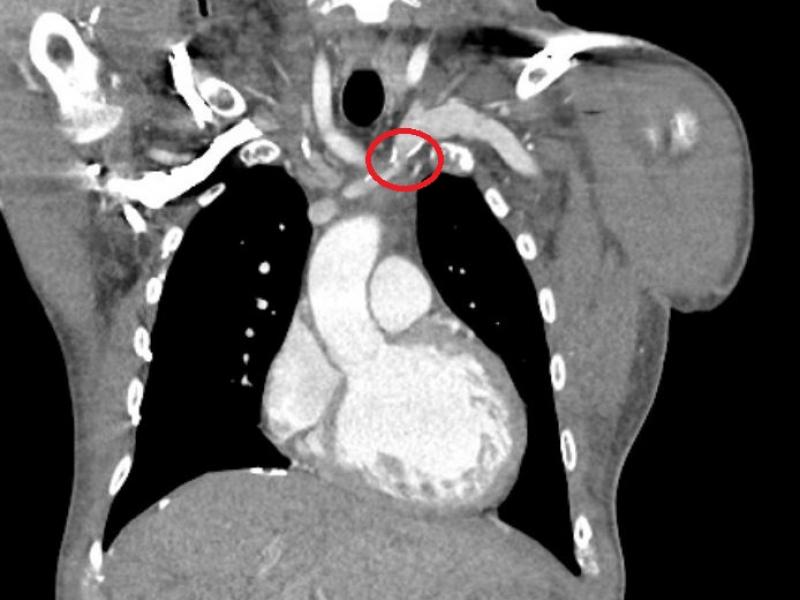 Advanced Practice: Thoracic Central Venous Obstruction!