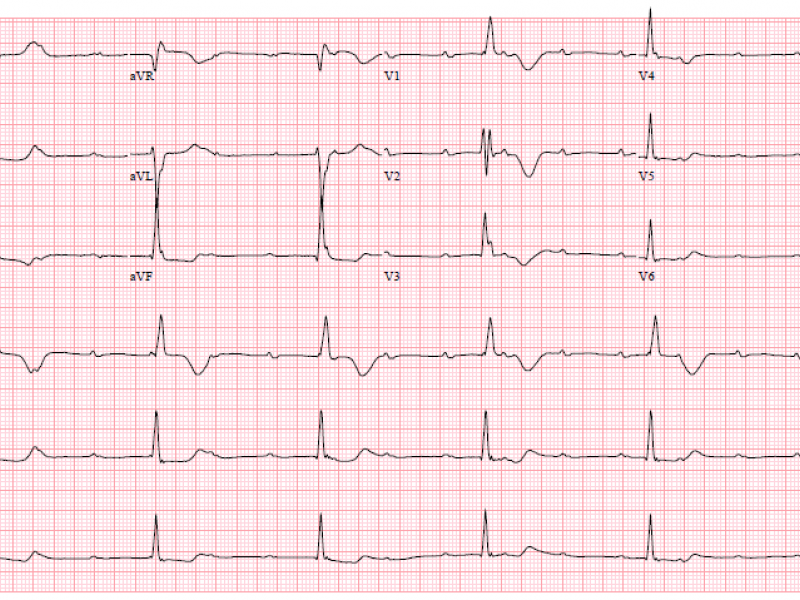 Back to Basics: Complete Heart Block