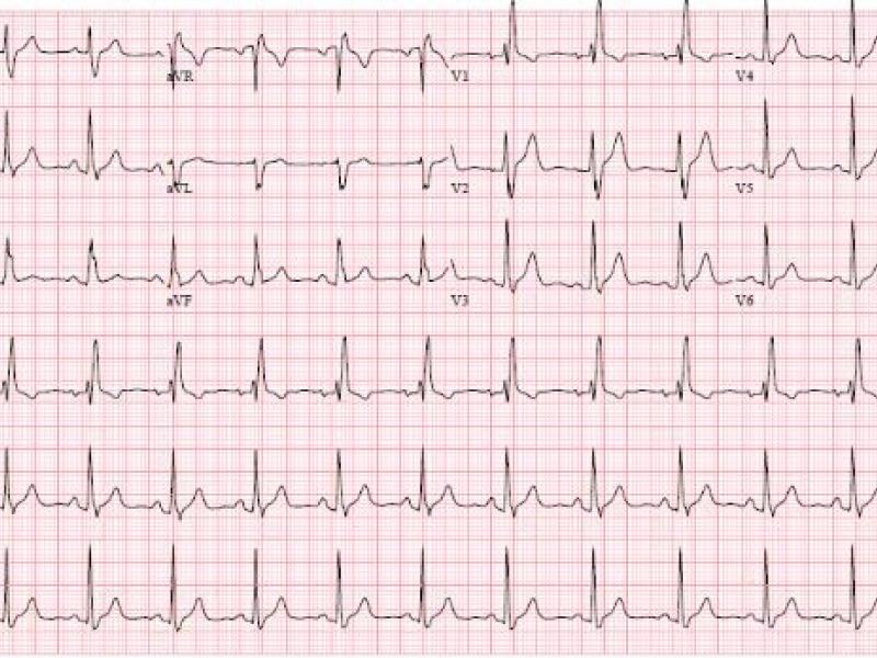 Critical Cases - Blunt Myocardial Injury