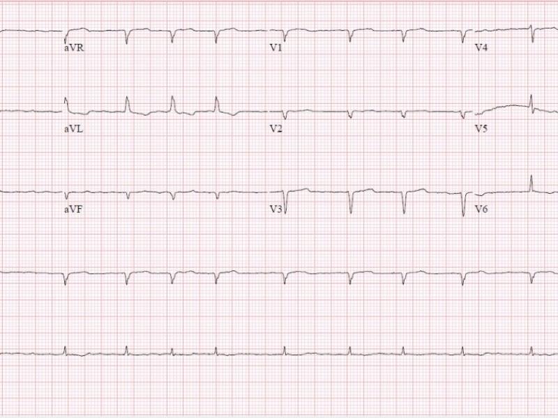 Critical Cases - Tension Pneumothorax!