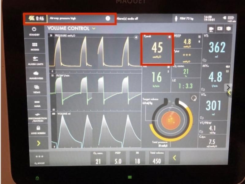 Mechanical Ventilation Alarms: High Airway Pressure 