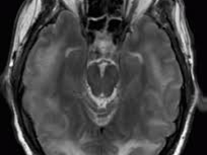 Critical Cases - Hypertensive Encephalopathy!