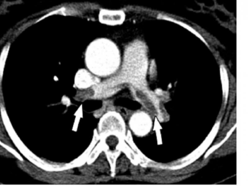 Initial choice of anticoagulation in PE