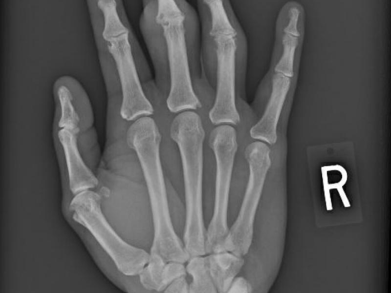 Critical Cases - Concomitant Gout and Septic Arthritis!