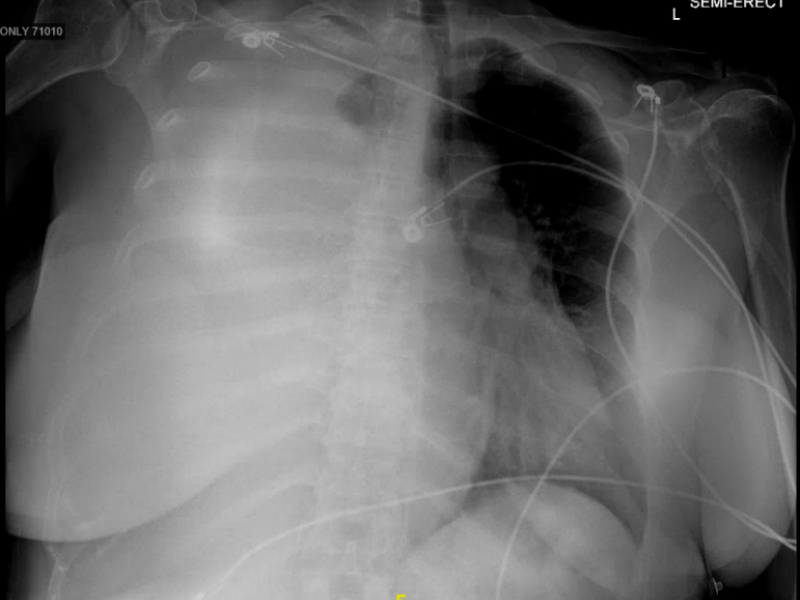 Interesting case of pleural effusion