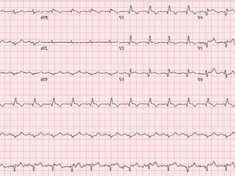 #EMConf: ECG review