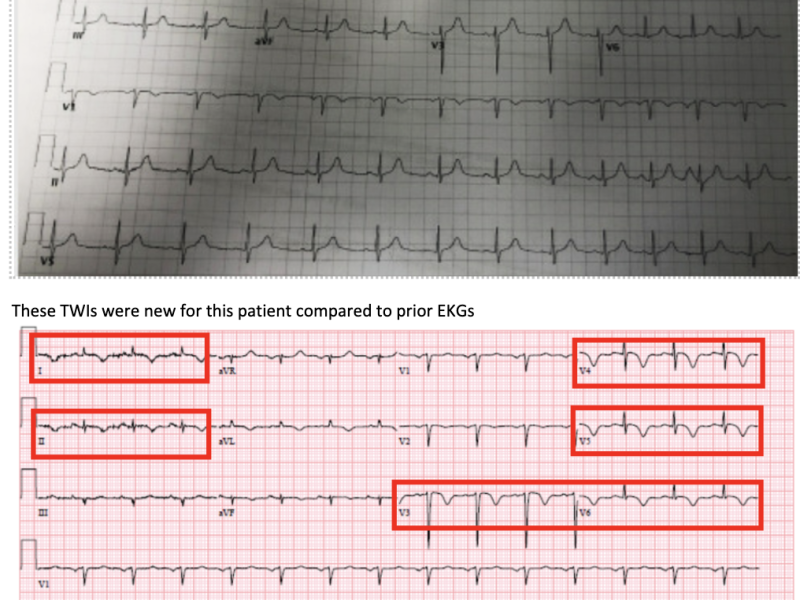 EMConference: Takotsubo's Cardiomyopathy