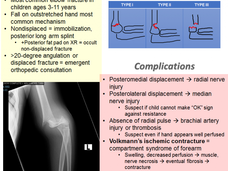 Back to Basics: Supracondylar Fractures