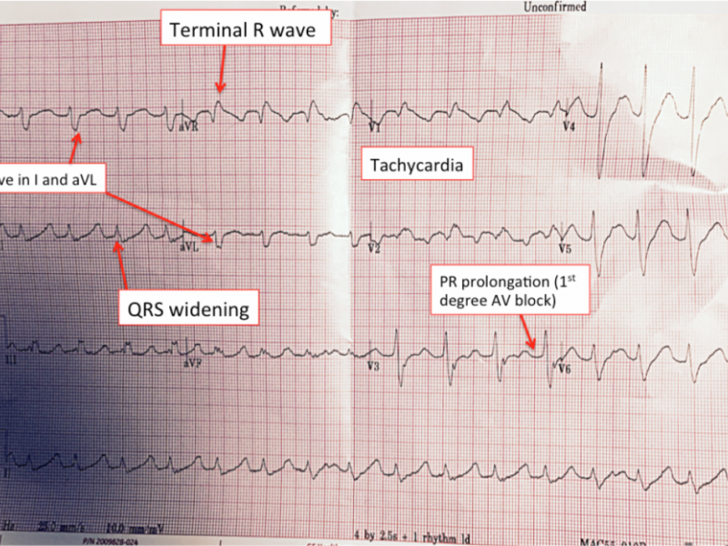 Back to Basics:  TCA Toxicity - EKG Findings