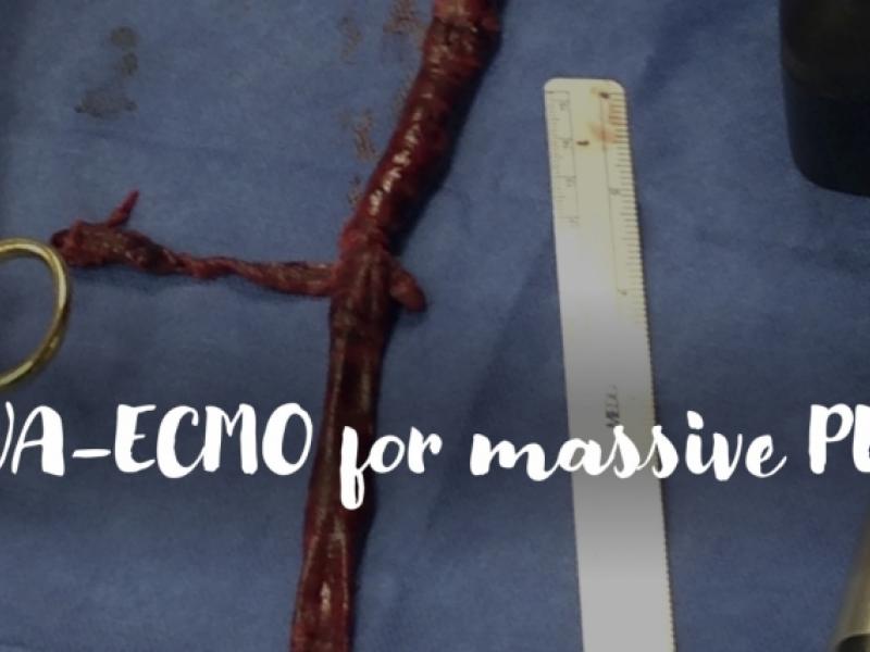 VA-ECMO for massive pulmonary embolism