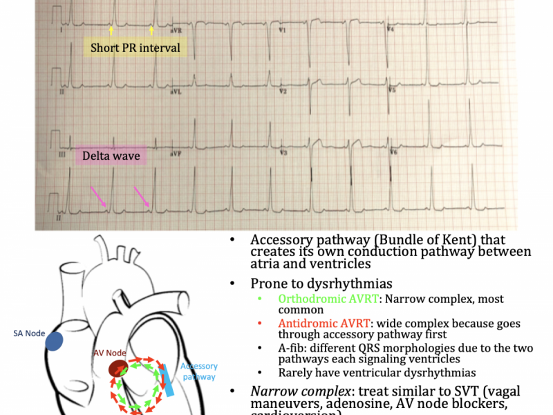 Back to Basics: Wolff-Parkinson-White (WPW)