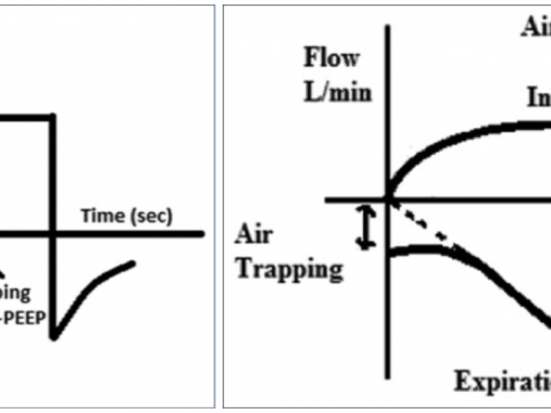 Diagnosis & Management of Auto-PEEP in Obstructive Pulmonary Disease