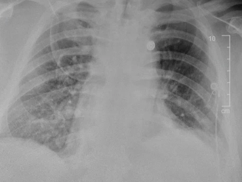 Critical Cases - T Trach respiratory distress emergency!