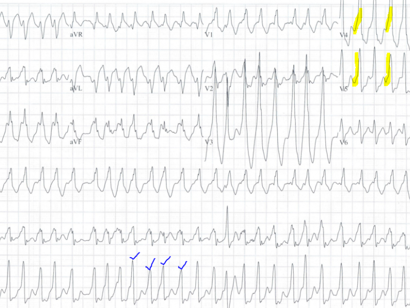 #EMconf: 24 y.o. with Near Syncope 