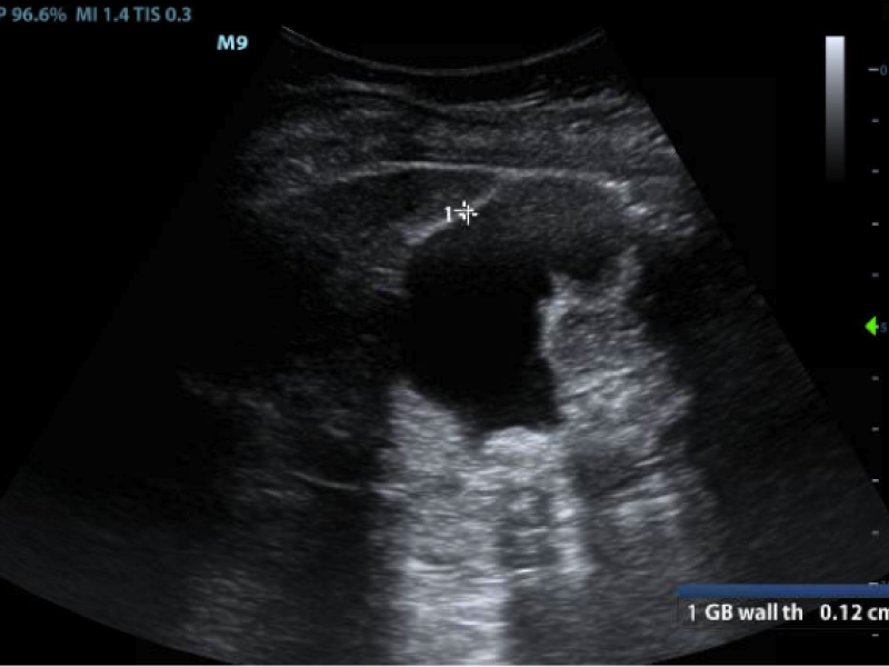 Imaging Case Answer: Cholecystitis vs Cholelithiasis