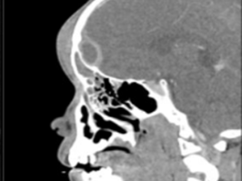 Critical Cases - Hypothermia Induced Arrhythmia!
