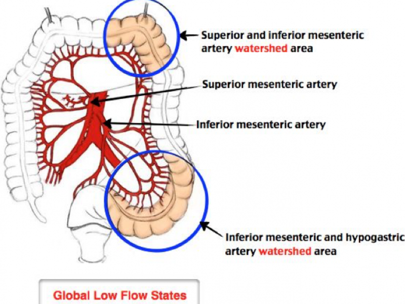 Back to Basics: Ischemic Colitis