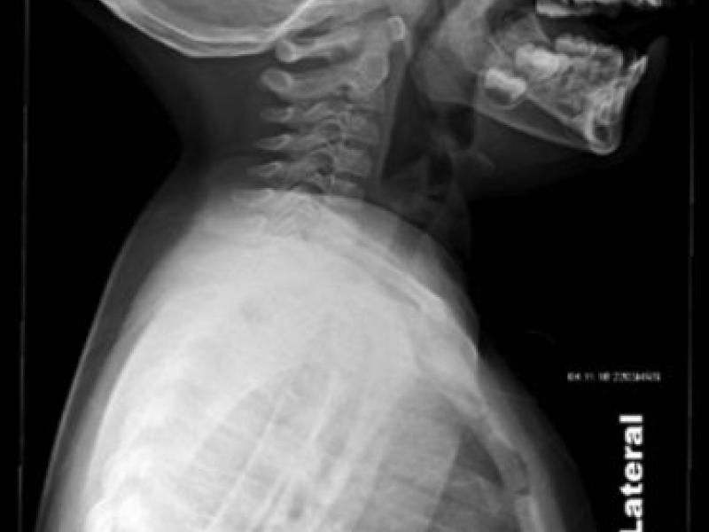 Imaging Case: 8 Year Old Girl with Shortness of Breath