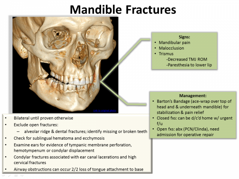 Back to Basics:  Mandible Fractures