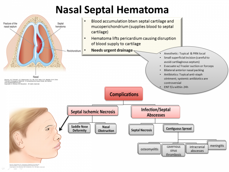 Back to Basics:  Nasal Septal Hematoma