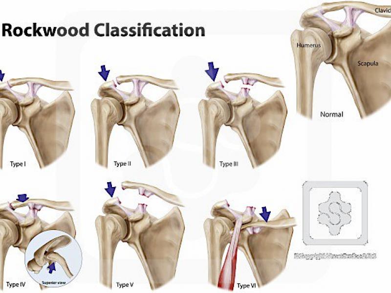 Orthopedic Injuries Around the NFL: Jordan Reed's Acromioclavicular Joint Separation