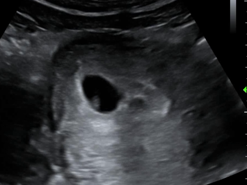 Advanced Practice: Linear Probe for Indeterminate 1st Trimester Transabdominal Ultrasound